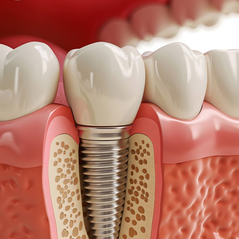 implantologie_leistung